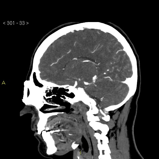 Basilar artery thrombosis (Radiopaedia 16260-15944 C 27).jpg