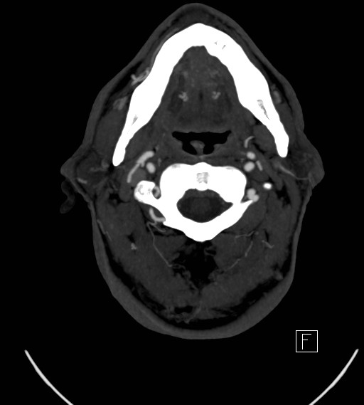Basilar artery thrombosis (Radiopaedia 26986-27163 A 1).jpg