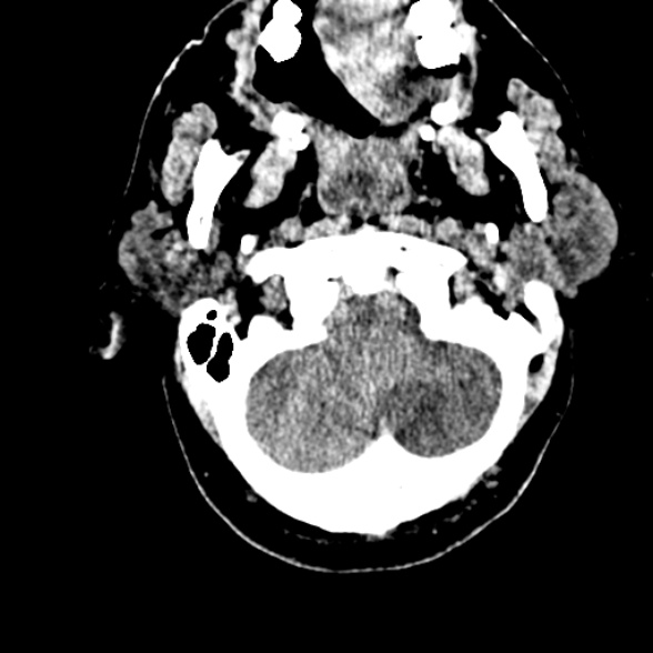 File:Basilar artery thrombosis (Radiopaedia 53351-59352 Axial non-contrast 19).jpg