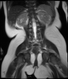 File:Beckwith-Wiedeman syndrome with bilateral Wilms tumors (Radiopaedia 60850-69233 Coronal T2 13).jpg