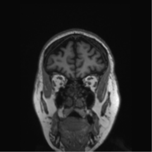 Behavioral variant frontotemporal dementia and late onset schizophrenia (Radiopaedia 52197-58083 Coronal T1 74).png