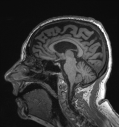 Behavioral variant frontotemporal dementia and late onset schizophrenia (Radiopaedia 52197-58083 Sagittal T1 44).png