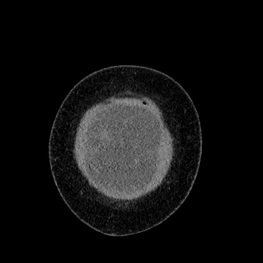 File:Benign leiomyoma with hydropic features (Radiopaedia 89250-106130 B 10).jpg