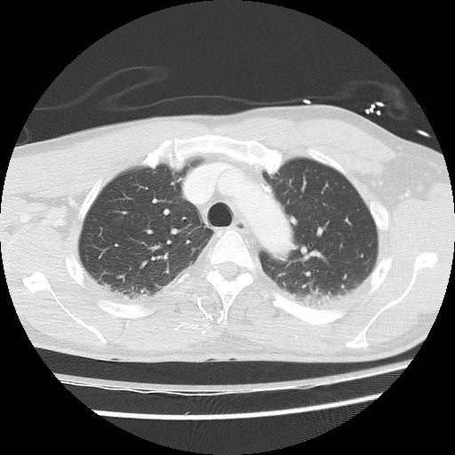 Benign post-traumatic pseudopneumoperitoneum (Radiopaedia 71199-81495 Axial lung window 25).jpg