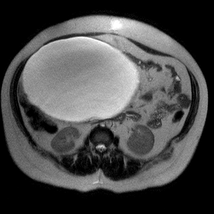 File:Benign seromucinous cystadenoma of the ovary (Radiopaedia 71065-81300 Axial T2 7).jpg