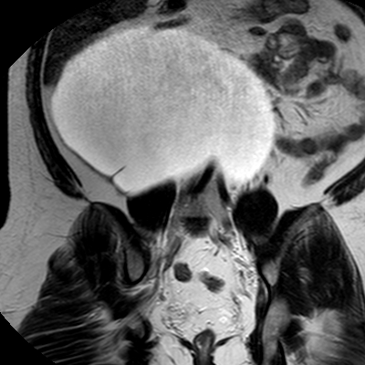 File:Benign seromucinous cystadenoma of the ovary (Radiopaedia 71065-81300 F 19).jpg