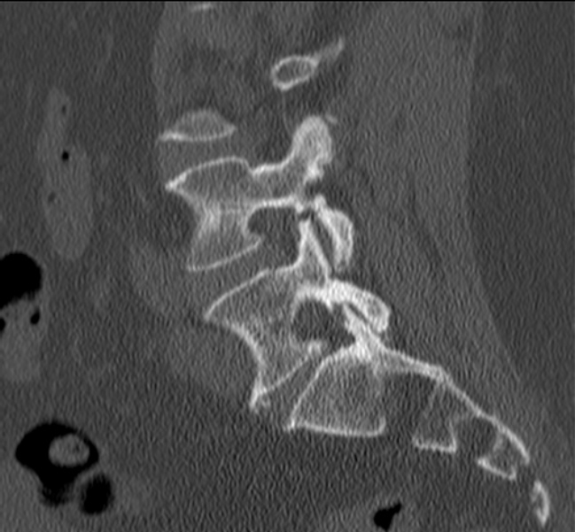 Bertolotti syndrome (Radiopaedia 24864-25128 Sagittal bone window 37).jpg