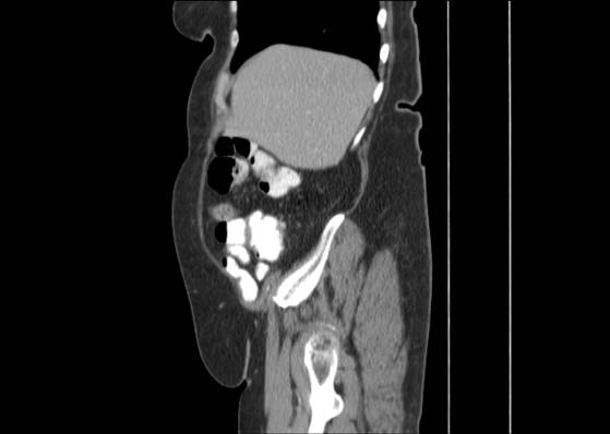 File:Bicameral celiacomesenteric aneurysm (Radiopaedia 55766-62327 B 13).jpg