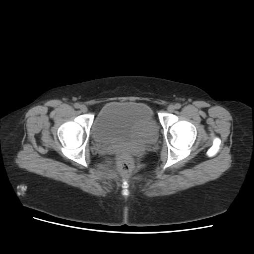 File:Bicornuate uterus (MRI) (Radiopaedia 49206-54296 Axial 2).jpg