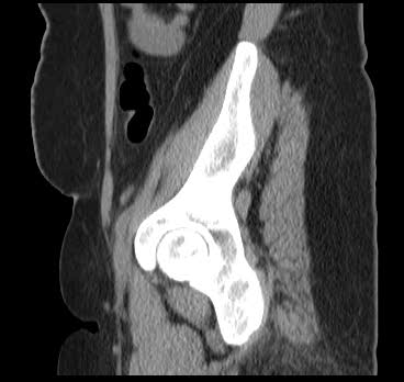 File:Bicornuate uterus (MRI) (Radiopaedia 49206-54296 Sagittal 16).png