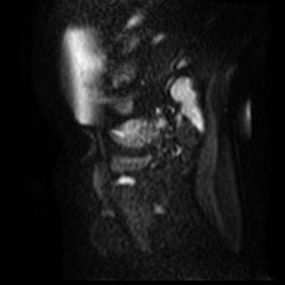 File:Bicornuate uterus (Radiopaedia 51676-57472 Sagittal DWI 33).jpg