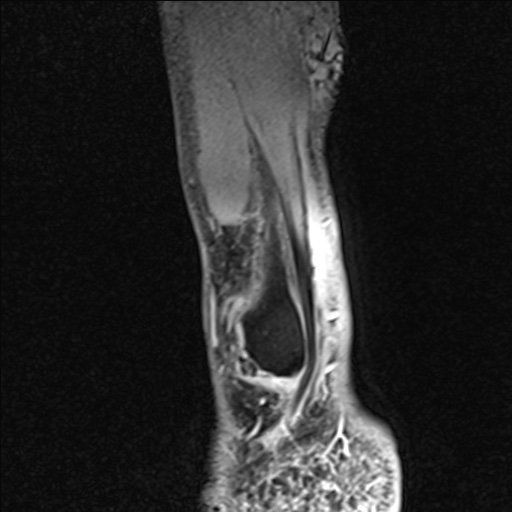 Bilateral Achilles tendon complete tear (Radiopaedia 81344-95051 Sagittal WE - Right 18).jpg