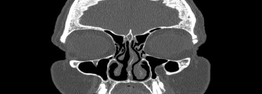 Bilateral Ectopic Infraorbital Nerves (Radiopaedia 49006-54084 Coronal bone window 16).jpg
