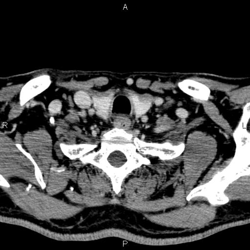 Bilateral Warthin tumors (Radiopaedia 84034-99263 Axial With contrast 58).jpg
