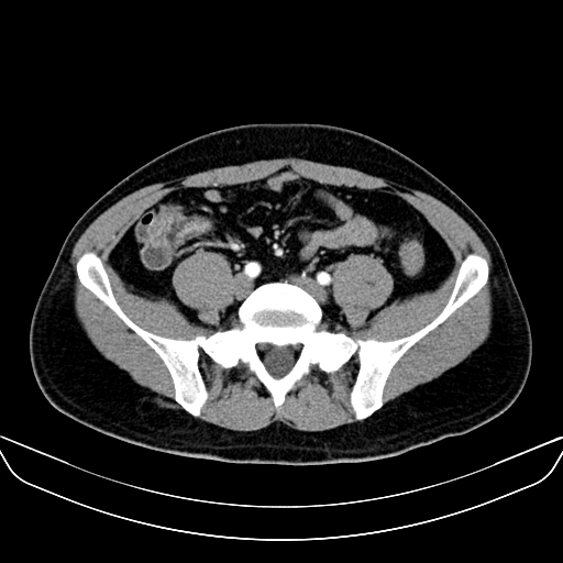 Bilateral accessory renal arteries with mild pelvi-ureteric junction (PUJ) obstruction (Radiopaedia 66357-75596 A 48).jpg
