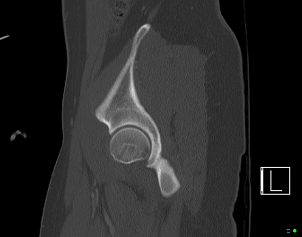 Bilateral acetabular fractures (Radiopaedia 79272-92308 Sagittal bone window 18).jpg