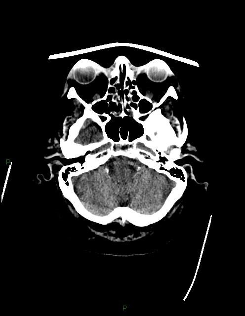 Bilateral acute middle cerebral artery territory infarcts (Radiopaedia 77319-89401 Axial non-contrast 15).jpg