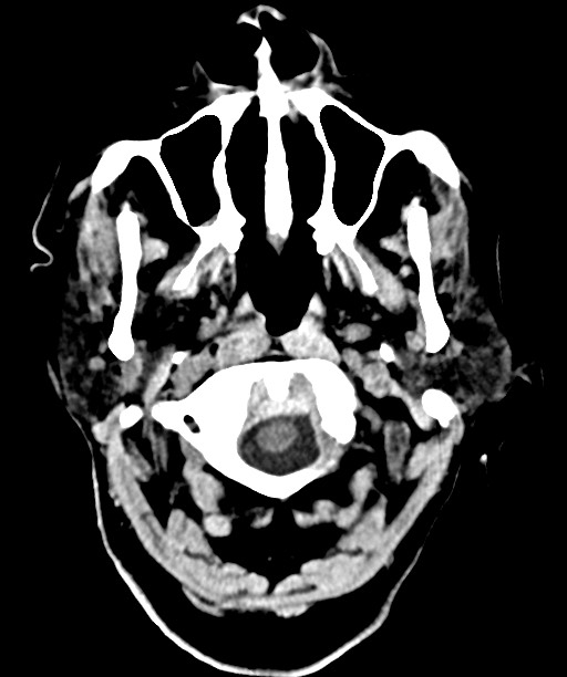 Bilateral acute on chronic subdural hematomas (Radiopaedia 78466-91146 Axial non-contrast 8).jpg
