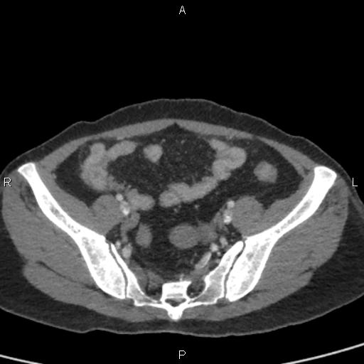 Bilateral adrenal gland hyperenhancement in pancreatitis (Radiopaedia 86642-102753 E 90).jpg
