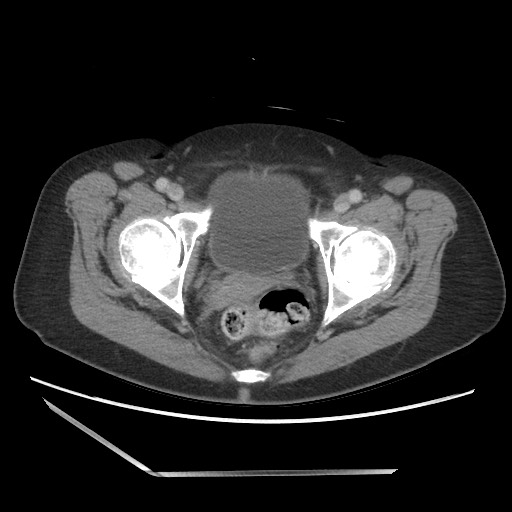 Bilateral adrenal granulocytic sarcomas (chloromas) (Radiopaedia 78375-91007 A 112).jpg