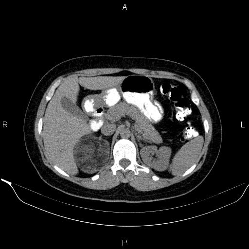 File:Bilateral adrenal myelolipoma (Radiopaedia 63058-71535 Axial non-contrast 50).jpg