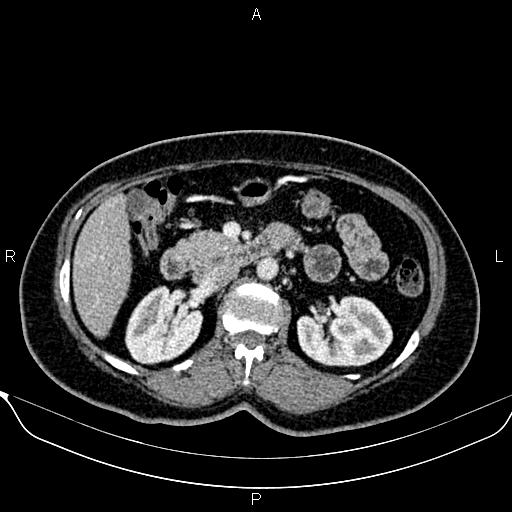 Bilateral benign adrenal adenomas (Radiopaedia 86912-103124 B 44).jpg