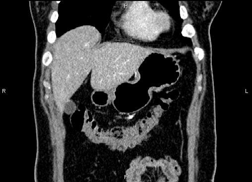 Bilateral benign adrenal adenomas (Radiopaedia 86912-103124 D 10).jpg