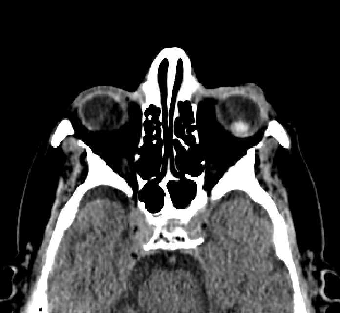 Bilateral ectopia lentis (Radiopaedia 89889-107013 Axial non-contrast 54).jpg