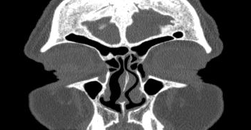 File:Bilateral ectopic infraorbital nerves (Radiopaedia 49006-54084 Coronal 62).png