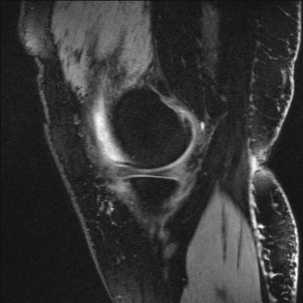 Bilateral focal pigmented villonodular synovitis (Radiopaedia 67643-77073 Sagittal T1 vibe 52).jpg