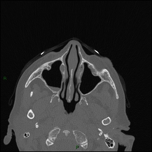 Bilateral frontal mucoceles (Radiopaedia 82352-96454 Axial bone window 190).jpg