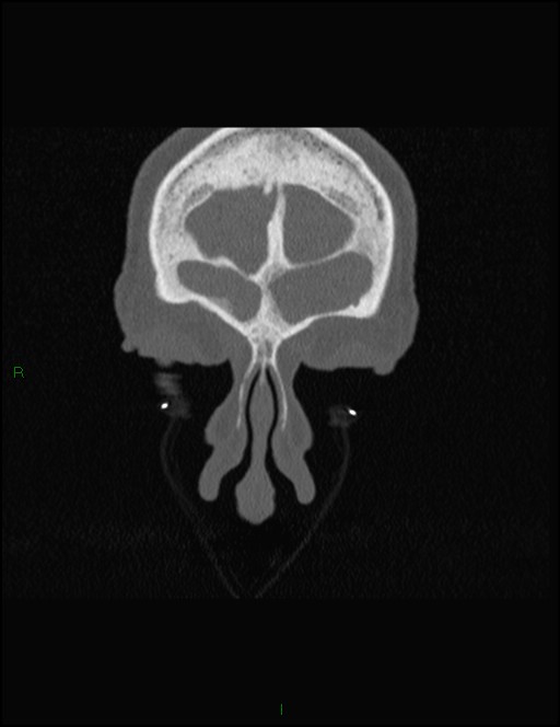 Bilateral frontal mucoceles (Radiopaedia 82352-96454 Coronal 53).jpg