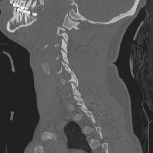 Bilateral locked facets (Radiopaedia 33850-35016 Sagittal bone window 36).png