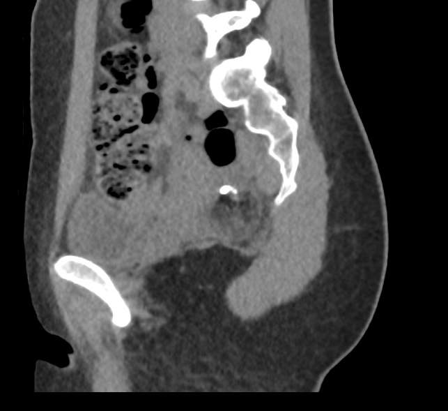 File:Bilateral mature cystic ovarian teratoma (Radiopaedia 88821-105592 D 19).jpg