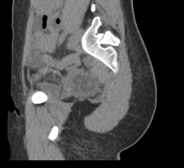 Bilateral mature cystic ovarian teratoma (Radiopaedia 88821-105592 D 53).jpg