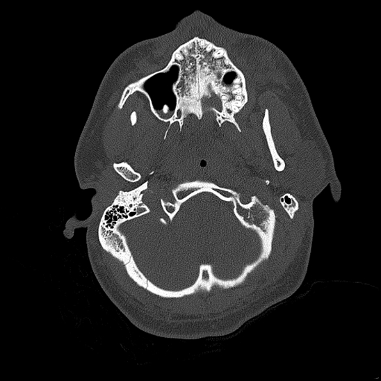 Bilateral occipital condyle fracture (type 2) (Radiopaedia 87675-104089 Axial bone thins 28).jpg