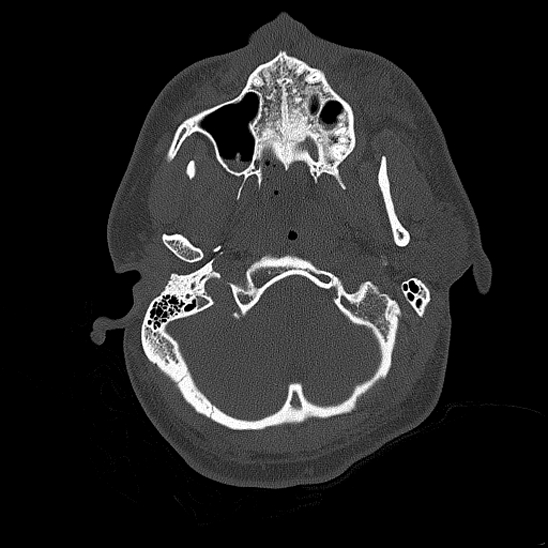 Bilateral occipital condyle fracture (type 2) (Radiopaedia 87675-104089 Axial bone thins 30).jpg