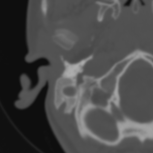 File:Bilateral otosclerosis (Radiopaedia 57237-64157 B 17).jpg