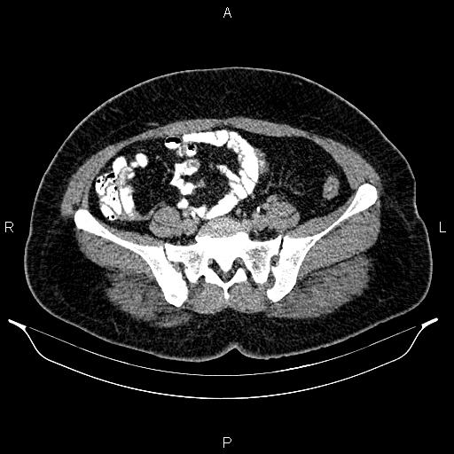 File:Bilateral ovarian dermoid cysts (Radiopaedia 85785-101603 Axial C+ delayed 58).jpg