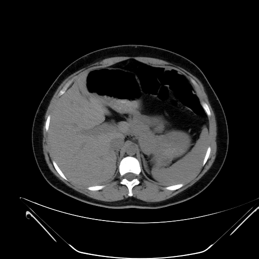 File:Bilateral ovarian mature cystic teratomas (Radiopaedia 79373-92457 Axial non-contrast 5).jpg