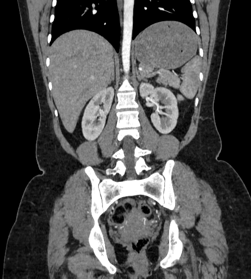 Bilateral ovarian mature cystic teratomas (Radiopaedia 79373-92457 B 59).jpg