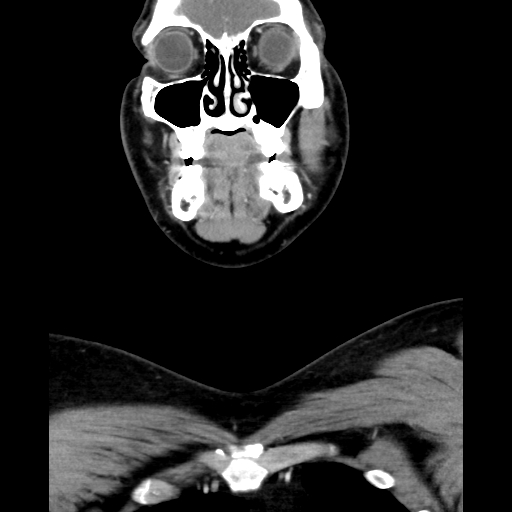 Bilateral peritonsillar abscess (Radiopaedia 85065-100610 Coronal 19).jpg