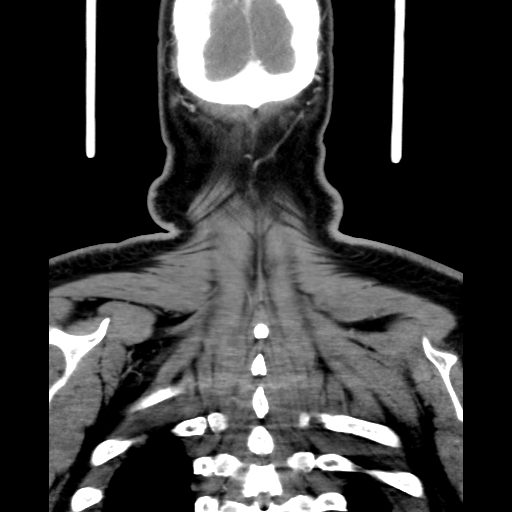 Bilateral peritonsillar abscess (Radiopaedia 85065-100610 Coronal 68).jpg