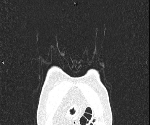 Bilateral pulmonary AVM (Radiopaedia 83134-97505 Coronal lung window 6).jpg