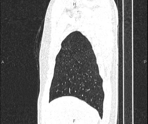 Bilateral pulmonary AVM (Radiopaedia 83134-97505 Sagittal lung window 24).jpg