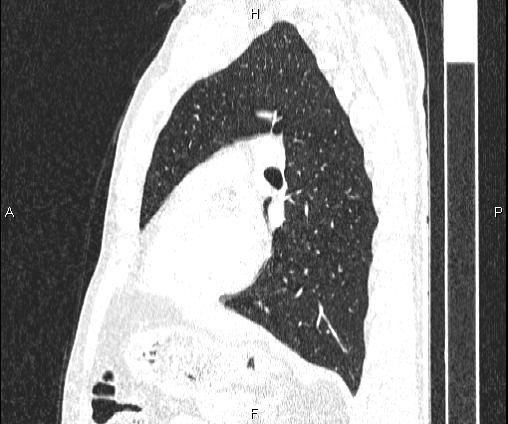 Bilateral pulmonary AVM (Radiopaedia 83134-97505 Sagittal lung window 72).jpg