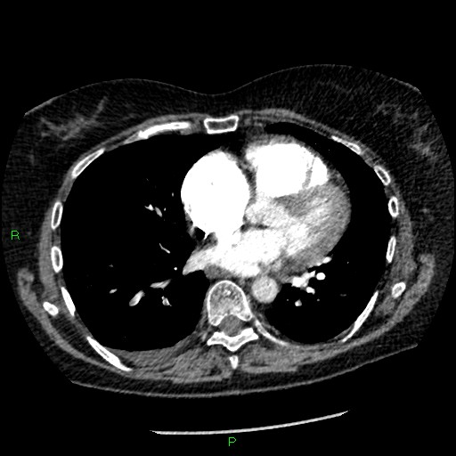 Bilateral pulmonary emboli (Radiopaedia 32700-33669 Axial C+ CTPA 67).jpg