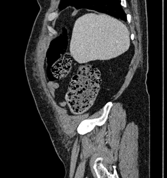 Bilateral rectus sheath hematomas (Radiopaedia 50778-56252 B 16).jpg