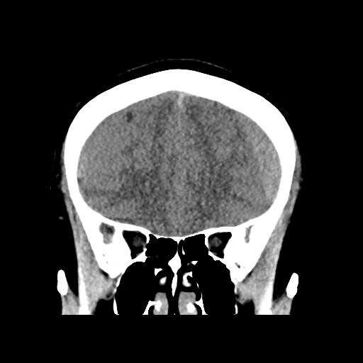 Bilateral subacute subdural hematoma (Radiopaedia 69240-79018 Coronal non-contrast 16).jpg