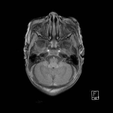Bilateral subdural hemorrhage and parietal skull fracture (Radiopaedia 26058-26190 Axial T1 11).png